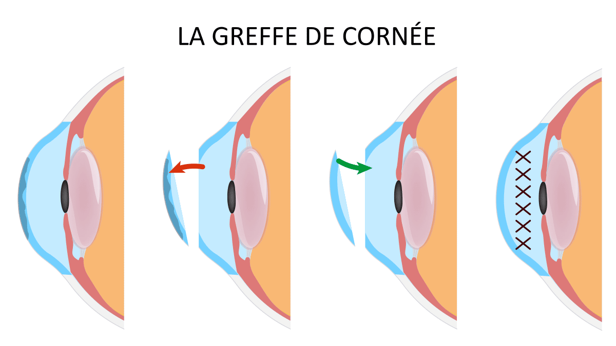 techniques-greffe-de-cornee